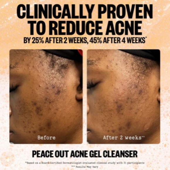 PEACE OUT | Acne Gel Cleanser - Picture 3 of 11